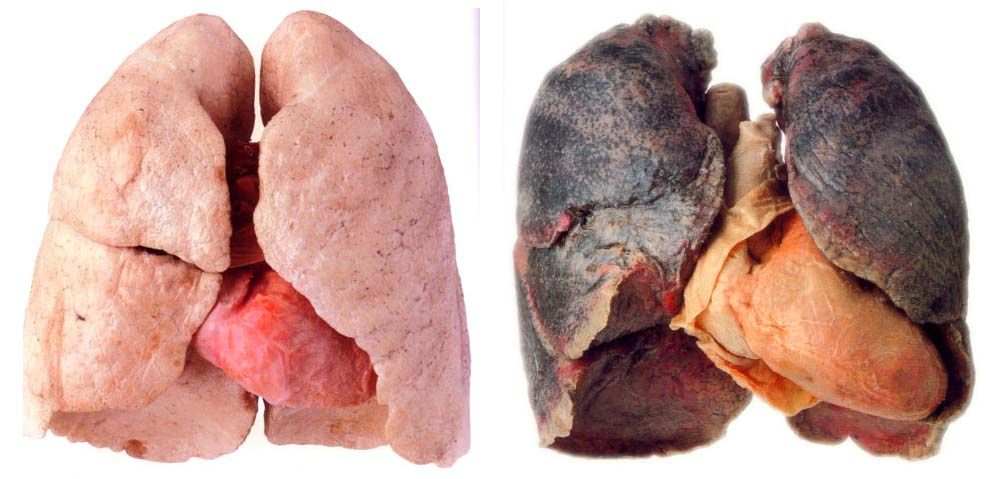 Normal lung vs. smoker's lung