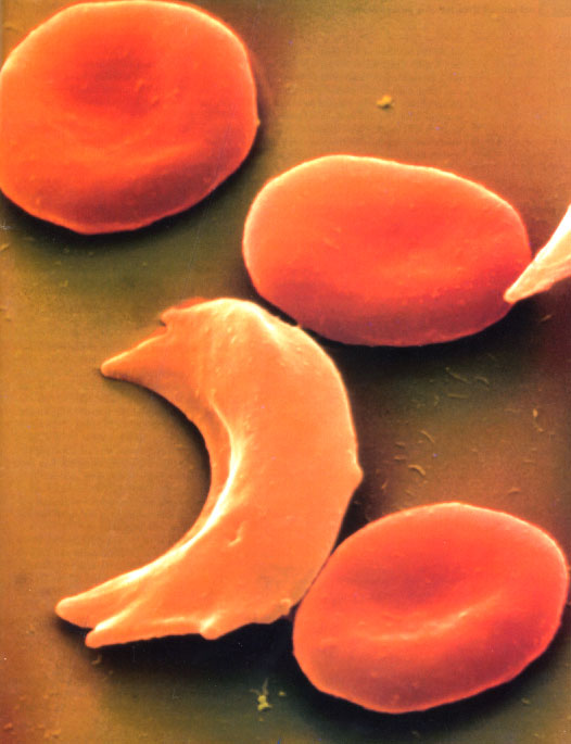 Sickle cells